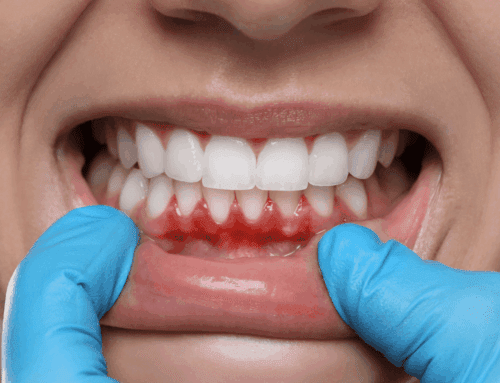Why Are My Gums Bleeding? 5 Causes (and When To See a Dentist)